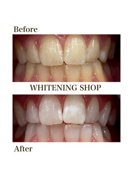 ホワイトニングショップ 府中店/ビフォーアフター