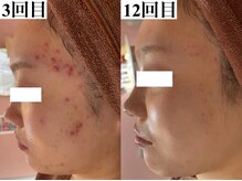 ホワイトアクア 天王寺本店(WHITE AQUA)/ハーブピーリング/大阪/天王寺