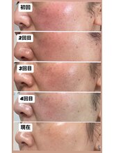 エムイーボーテ(me.Beaute)/お肌を土台から強くする