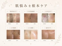 ベルスキン(Bell skin)