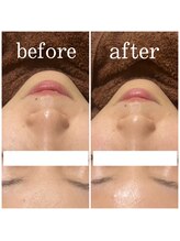 アイリーン(IRENE)/毛穴洗浄の効果実感♪