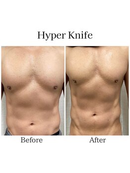 ハリルル 併設 GLケンタ鍼灸整骨院(HARILULU)/ハイパーナイフ