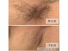 【夏前に！お試し脱毛】ひじ下＆わき＆うなじ【女性】¥5,600【男性】¥7,600