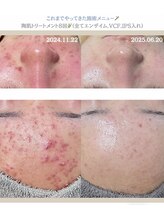 クレヴィー(Creviy)/圧倒的な肌質改善