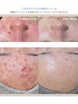 クレヴィー(Creviy)/圧倒的な肌質改善