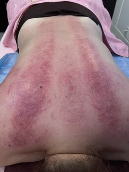 スイクウ ネオ(neo)/スライド式カッピングの跡