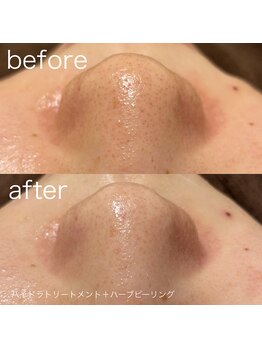 ルルラ リコ(lulula rico)/症例写真/ハイドラ毛穴洗浄