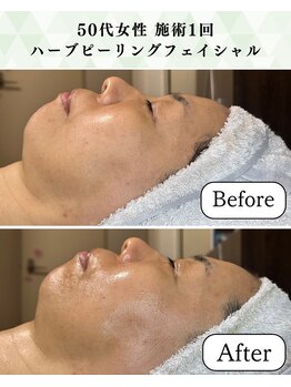 シーフェイス 横浜店(SEE FACE)/毛穴肌質改善ハーブピーリング