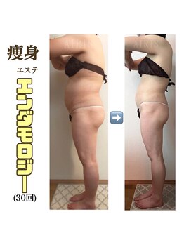 アイリス(AIRIS)/痩身/リンパケア/マッサージ