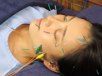 ビースタイル(B-style)/【美容鍼灸】電気美容鍼施術