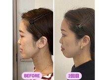 小顔22 ボルティ 赤坂支店(Bolty)/20代：小顔シンメトリー（2回）