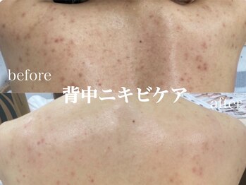 ネオリー(neorii)/背中ケア　ハーブピーリング