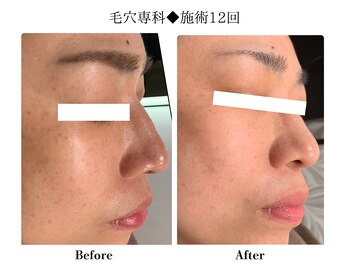 フレイヤ(FREYA)/毛穴専科Before→After