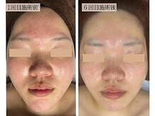 リノン(LINON)/ハーブピーリング 施術回数６回