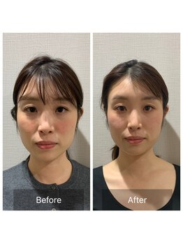 ニコ(NICO)/ビフォーアフター　３回目