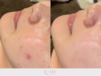 ルーミー 南青山(LUME)/繰り返しニキビ/アクネ菌ピール