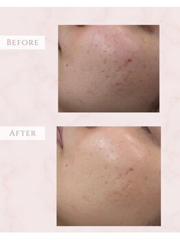 ルミナ(LUMINA)/光ハリつやケア+ニキビケア