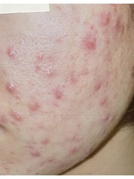 サロンドカイ(Salon de Kai)/肌育成プログラム 初回