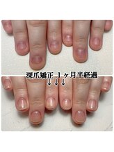 スマイルニコ(smile nico)/めり込み爪も深爪矯正で変わる！