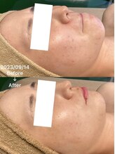 月のあかり/ハーブピーリング