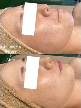 月のあかり/ハーブピーリング