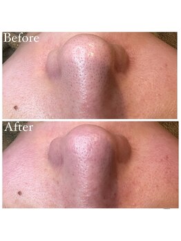 マドモアゼル 麻布十番/毛穴洗浄