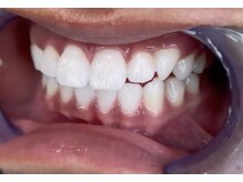 大分唯一Bright oral式ホワイトニングで艶のある美しい仕上がり