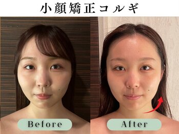 スイスパ 恵比寿(翠SUI SPA)/【小顔矯正コルギ】Before/After