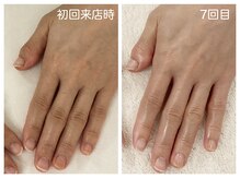 キレイテ 福岡天神店/乾燥と関節のくろずみ