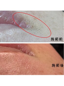 フルールスレーヌ(Fleur Sereine)/シュガーリング+光脱毛