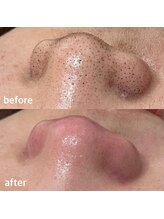 シェリーミル(Cherie Miru)/エクストラクションBefore/After