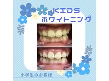 ホワイトニングプラス(Whitening+)/キッズホワイトニング