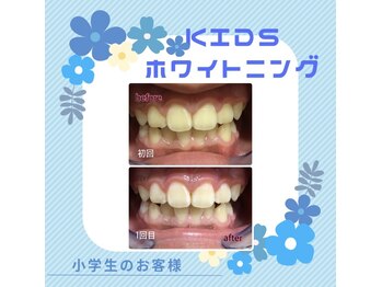 ホワイトニングプラス(Whitening+)/キッズホワイトニング