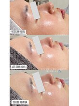 クレヴィー(Creviy)/韓国式3D毛穴洗浄＆REVlハーブ