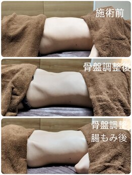 シャルールプラス(chaleurplus)/骨盤調整+hot腸もみ後