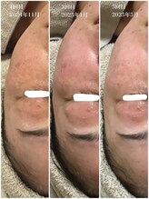 アミィ(amii)/肌育ボンバーフェイシャル