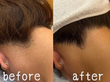 リーインカーナ アーティスト(REINCARNA ARTIST)/襟足脱毛【襟足美人】