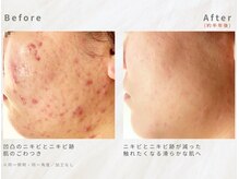 メレ(mele)/20代赤み／ニキビケア・毛穴