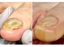 名古屋巻き爪専門 Proの雰囲気（他店で断られたお爪、爪を剥ぐしかないと言われたお爪も可能です）