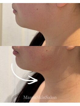 マウム(Maum)/二重あごすっきり・Vライン