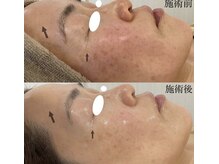 ミセル(MISEL)/人気No.1韓国式ピーリング