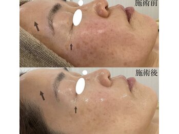 ミセル(MISEL)/人気No.1韓国式ピーリング