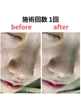 縁 整体院(en)/ハイドラ/毛穴洗浄