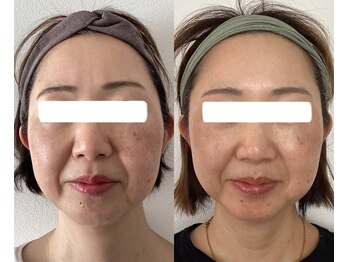 エムズサロン(m’sサロン)/初回→9回のビフォーアフター