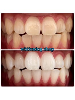 ホワイトニングショップ 越谷せんげん台店/Before After美白ホワイトニング