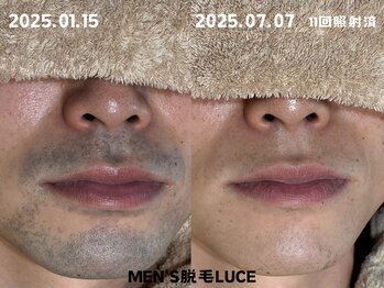 ルーチェ/【ヒゲ脱毛】2週間に1度の照射