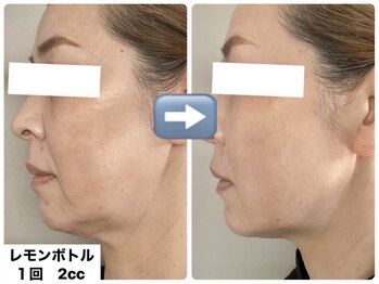 ゼアー(THERE FY.)/脂肪による頬のふくらみに