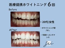 セイ(sei)/ホワイトニングビフォーアフター
