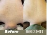 繰り返す背中ブツブツ・色素沈着・黒ずみ◆選べる剥離有/無ハーブピーリング