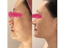 スキンラボ 新宿(@SkinLabo)/水光リフト★高密度ナノ超音波